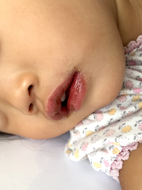 川崎病の主要症状の口唇がいつもより赤くなる